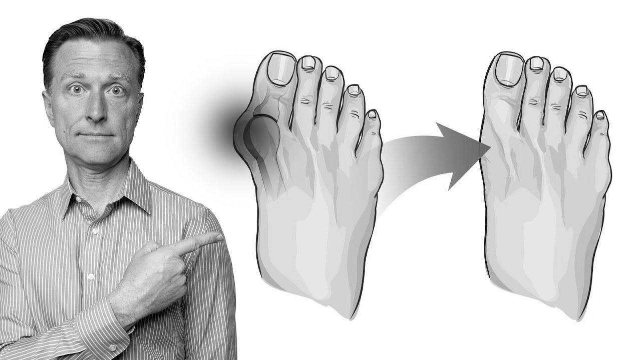 How to Repair Bunions in 3 Steps