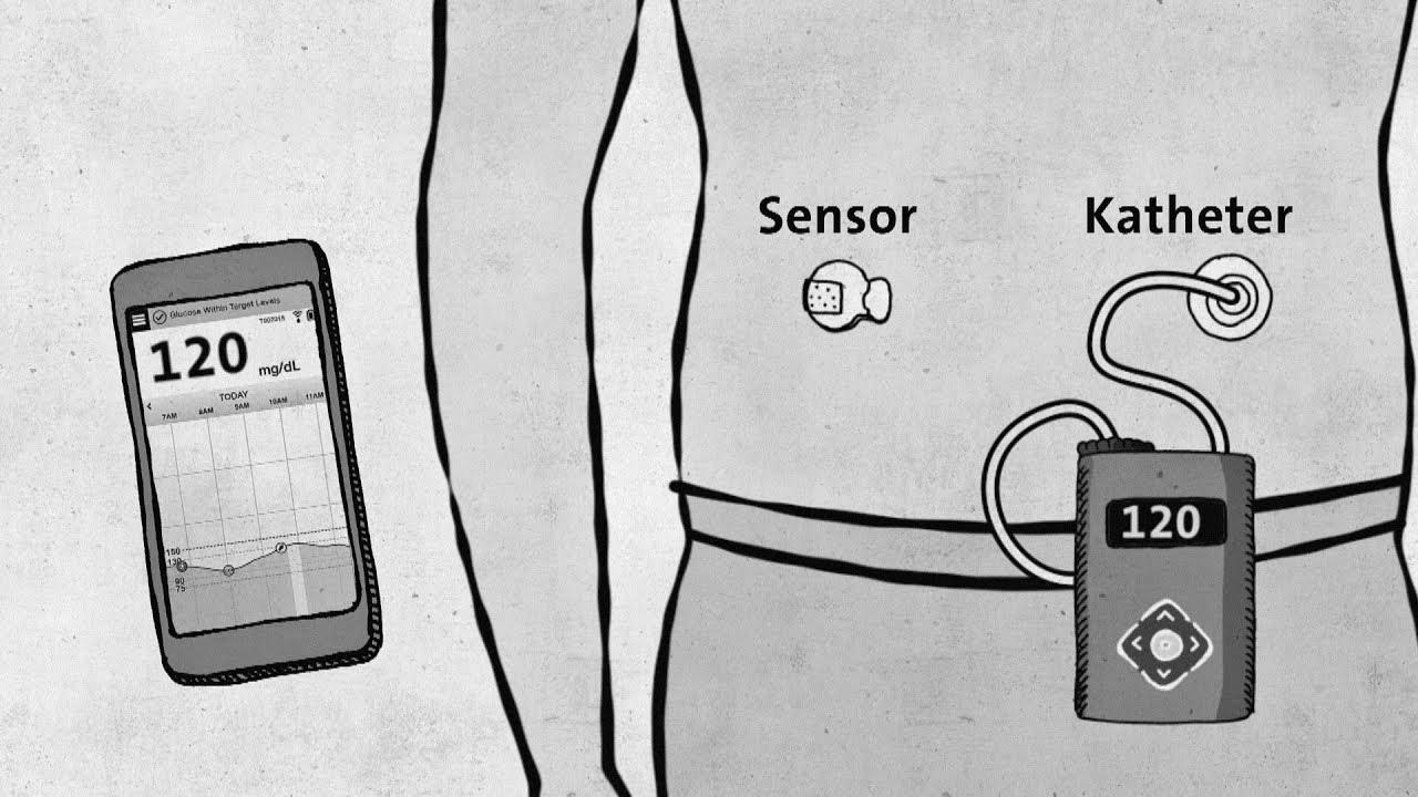 Kind 1 diabetes – modern know-how with out approval – good to know